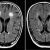 Una resonancia magnética mostró manchas blancas en mi cerebro. ¿Qué significa esto?